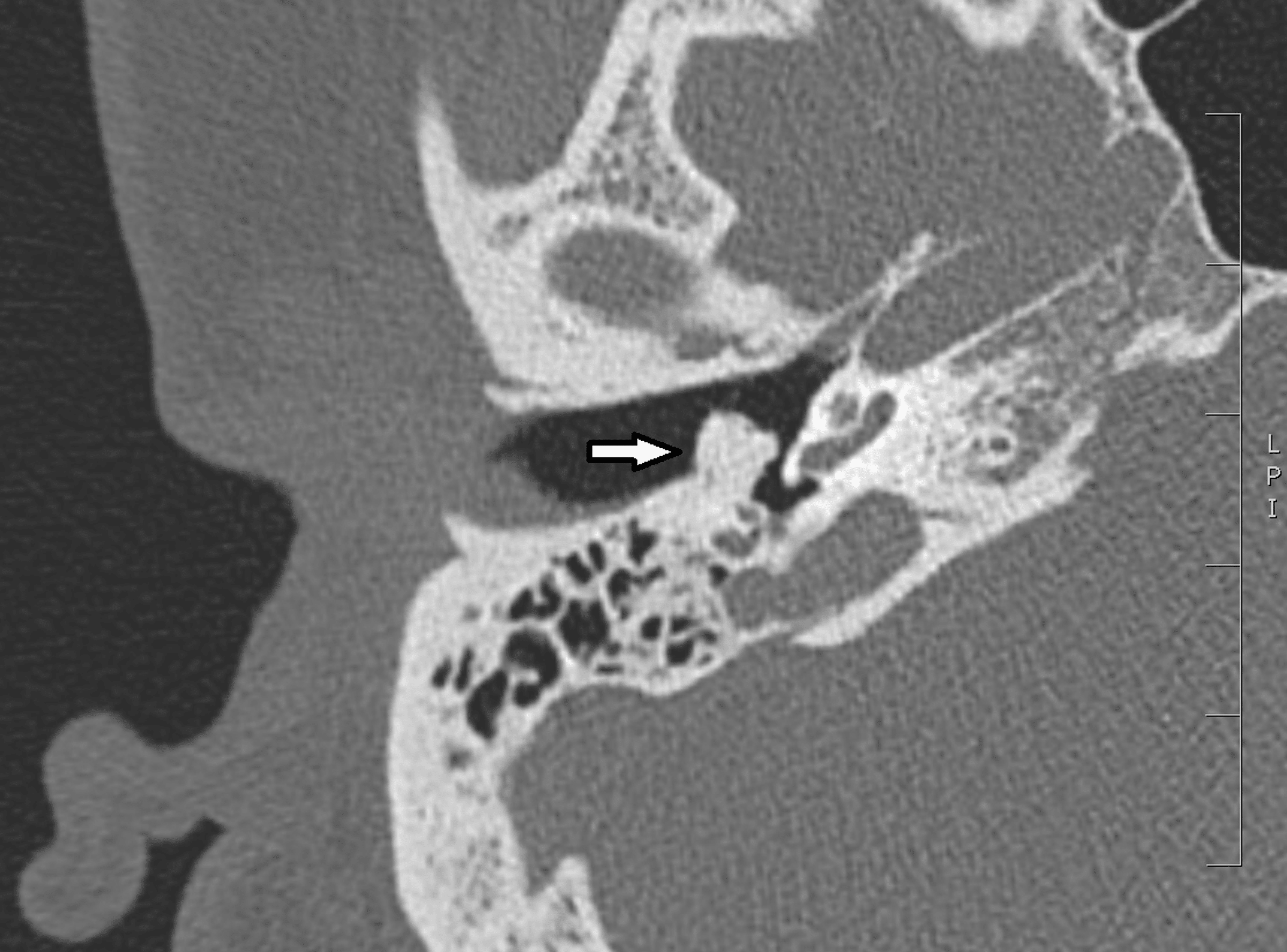 Cureus Middle Ear Osteoma With Assimilation of Ossicles An Unusual