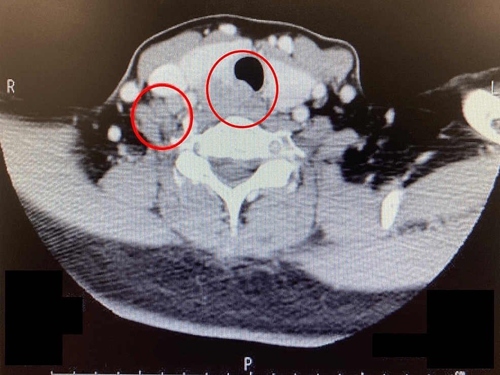 Anesthetic Management Using the Oxygen Reserve Index for Tracheal