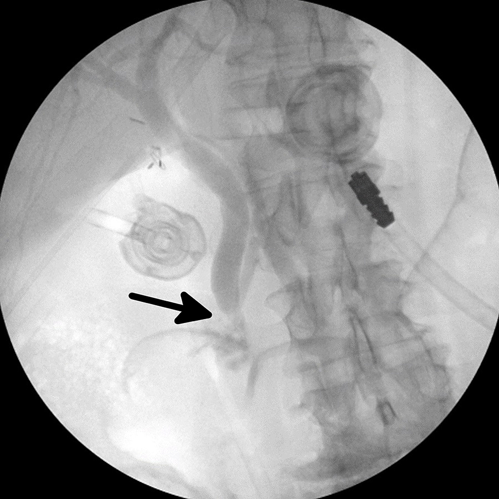 Novel Technique For Laparoscopic Common Bile Duct Exploration Using ...