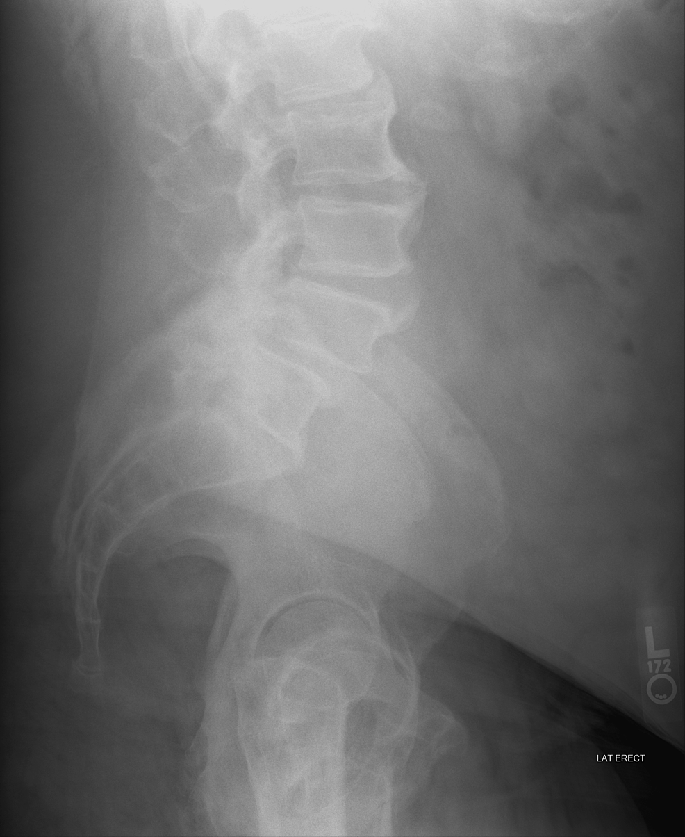 Effectiveness of Intraoperative Neuromonitoring in a Patient Undergoing ...