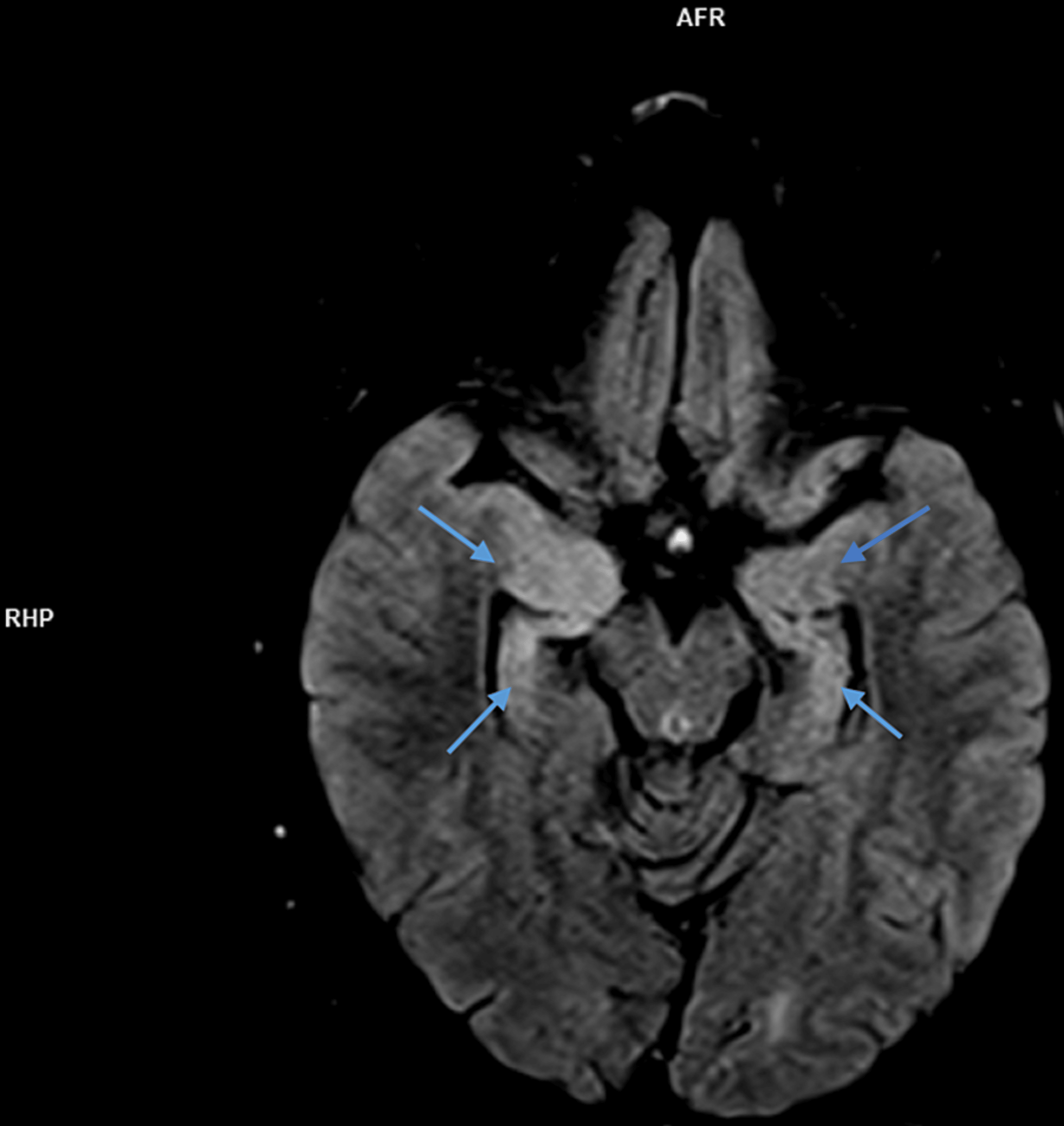 Cureus Anti Leucine Rich Glioma Inactivated 1 Anti LGI 1 Limbic Encephalitis And New Onset