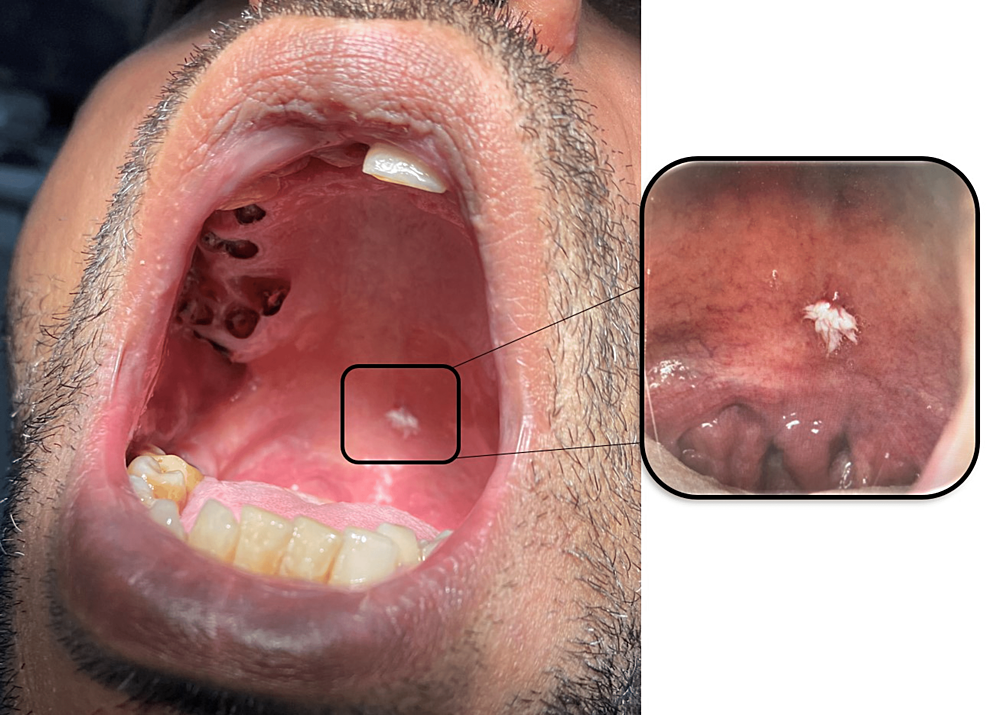 oral verruca vulgaris