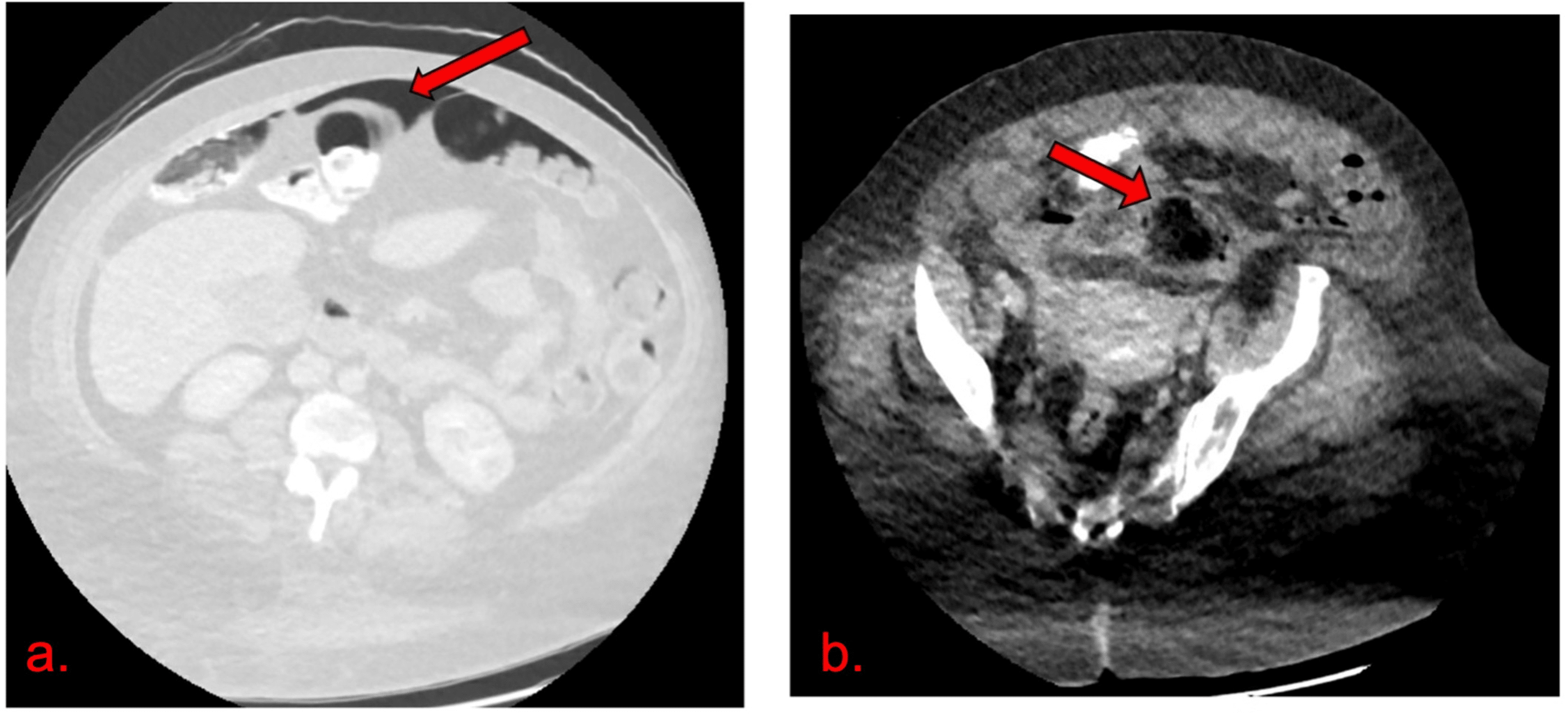 Cureus Rare Presentation Of Stercoral Ulcer Spontaneous Perforation Without Preceding 6833