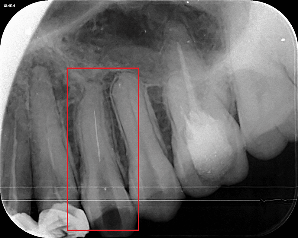 Root Canal Therapy in Burnaby