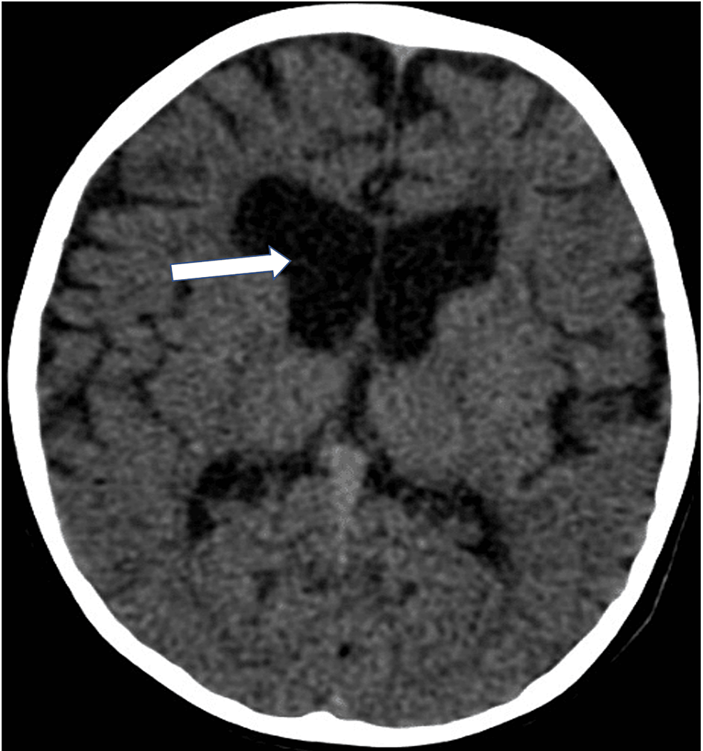 congenital-myasthenic-syndrome-associated-with-slc25a1-gene-variant