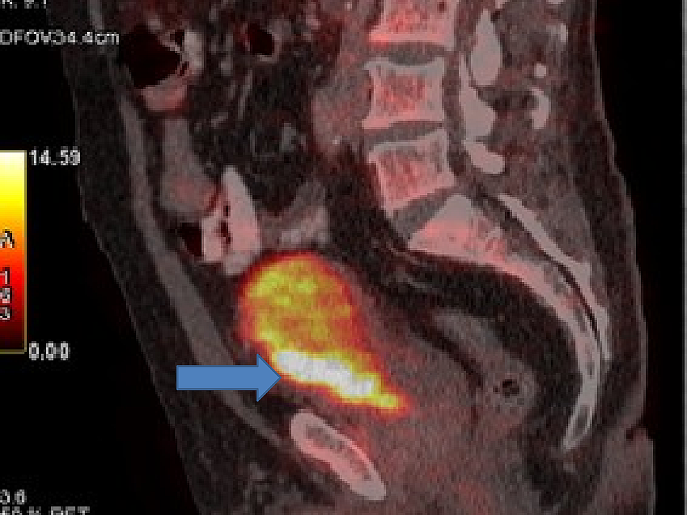 Positron-emission-tomography-(PET)-showing-bladder-cancer-involving-inferior-half-of-urinary-bladder-with-perivesical-extension.