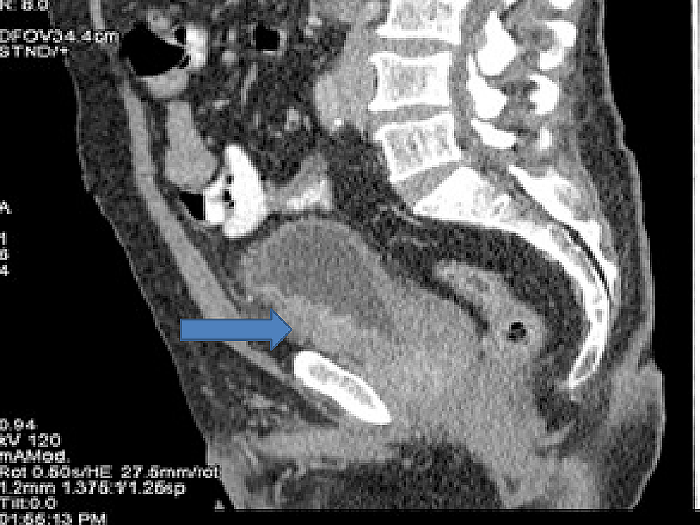 Computed-tomography-(CT)-showing-bladder-cancer-involving-inferior-half-of-urinary-bladder-with-perivesical-extension.