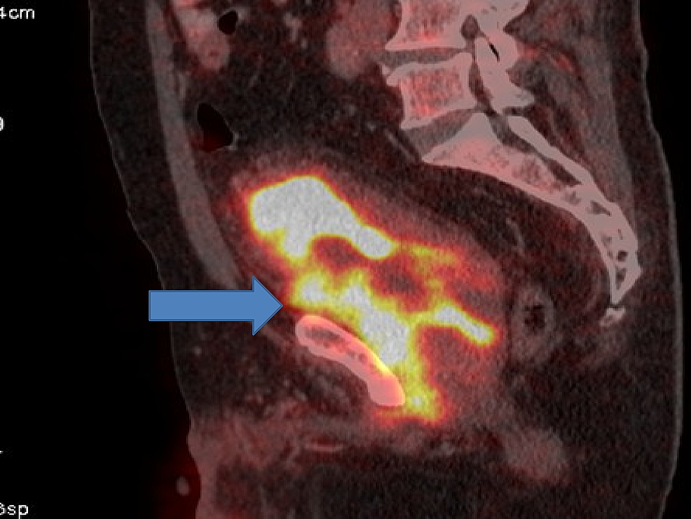 Positron-emission-tomography-(PET)-showing-progression-in-urinary-bladder.