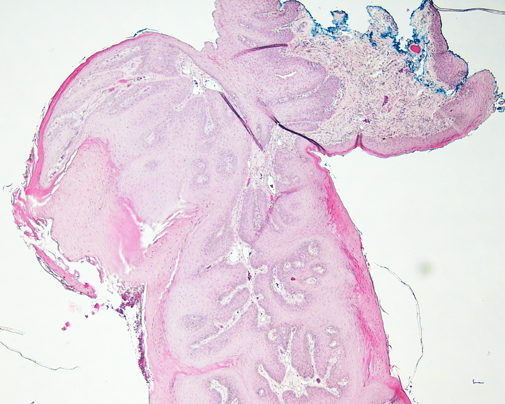Cureus Squamous Papilloma of the Soft Palate A Case Report