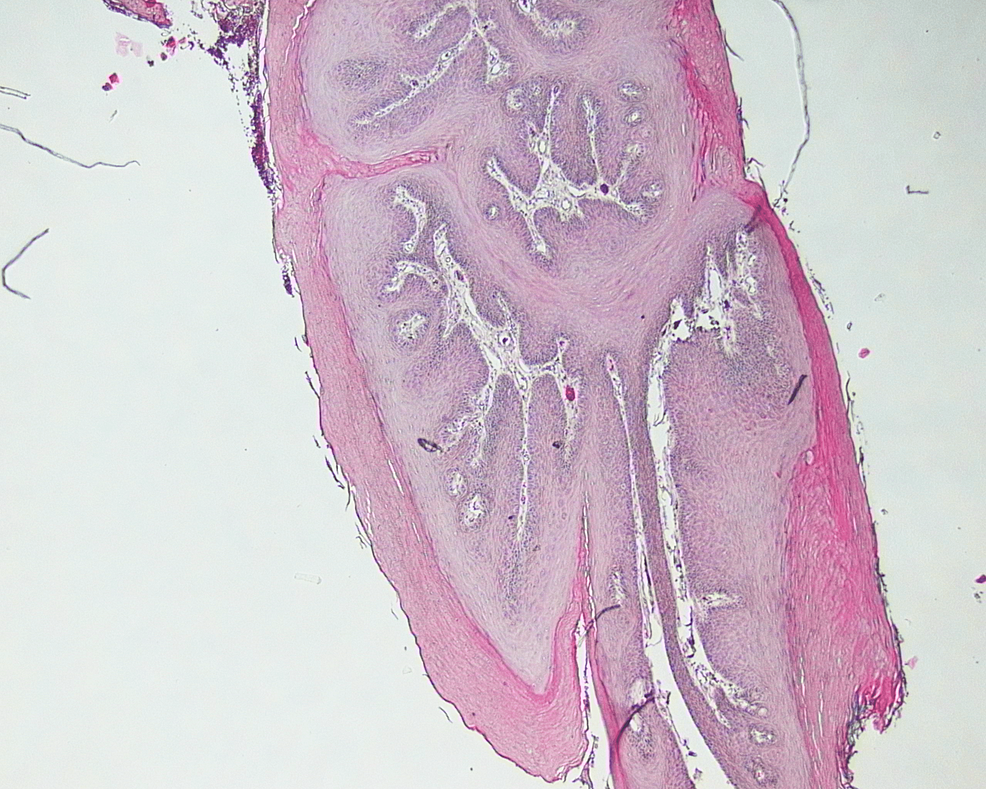 Cureus Squamous Papilloma of the Soft Palate A Case Report