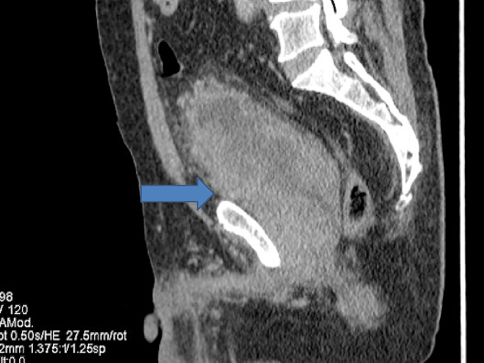 Computed-tomography-(CT)-showing-progression-in-urinary-bladder.