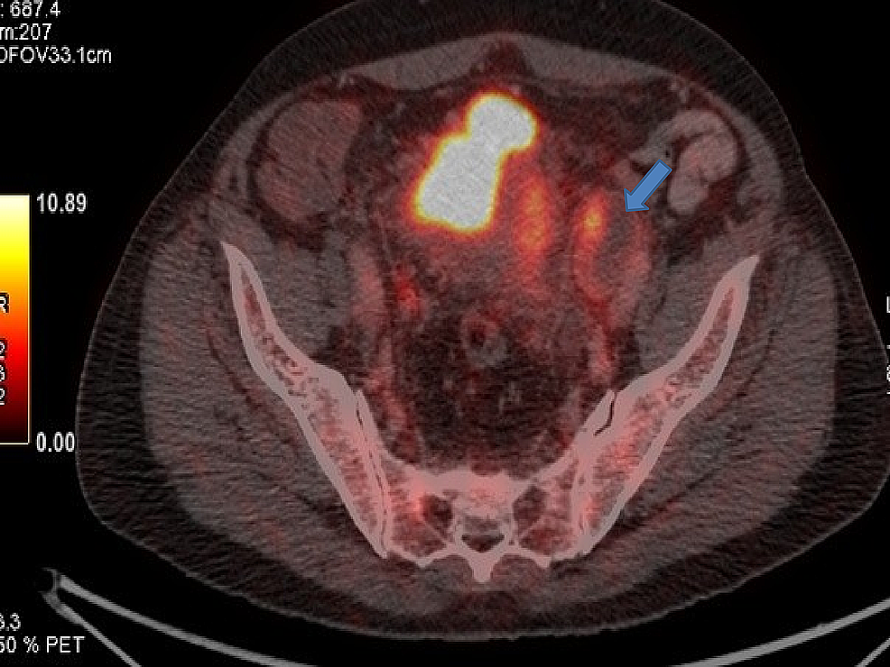 Positron-emission-tomography-(PET)-showing-progression-in-left-internal-iliac-lymph-nodes.