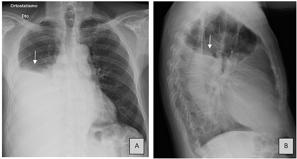 A Gelatinous Pleural Effusion as a Diagnostic Clue | Cureus