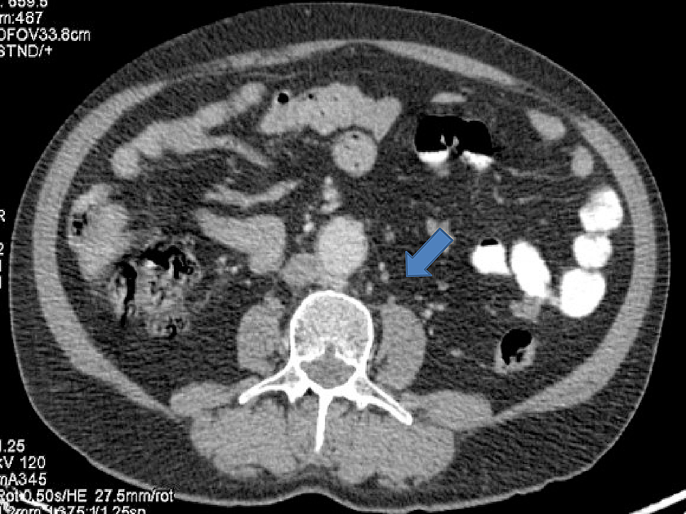 Computed-tomography-(CT)-done-after-17-months-of-starting-radiation-and-immunotherapy-showing-disease-in-complete-remission-and-no-para-aortic-lymph-node-was-seen.