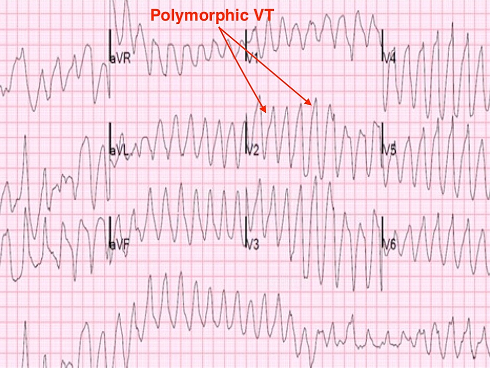 Ventricular Tachycardia Storm Induced by Loperamide Abuse | Cureus