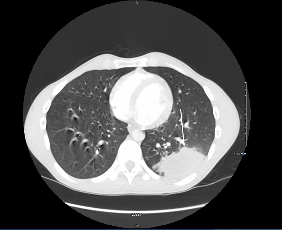 Lung Mass Surgery Recovery