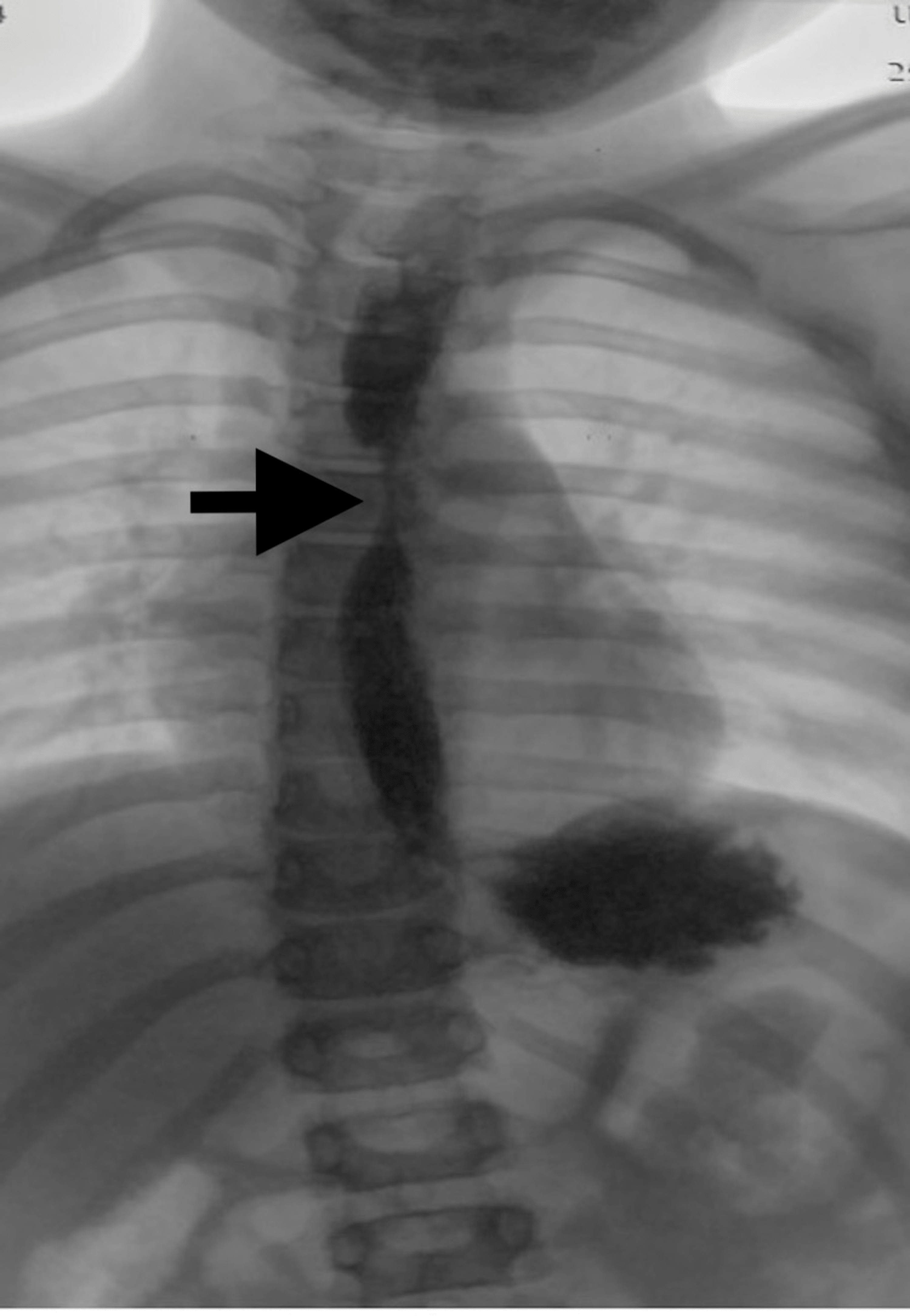Cureus Eosinophilic Esophagitis in the Setting of Prior Caustic Ingestion