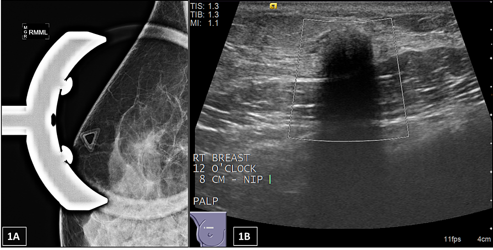 Breast ultrasonography revealed a 36-mm irregular mass at the 9 o'clock