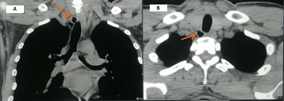 A and B) Diverticulum tracted to approach de neck dissection C