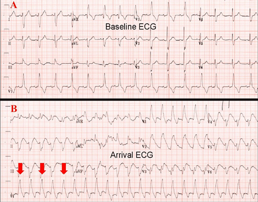 A: Follow-up electrocardiogram showing a 0.5 mm convex ST-segment