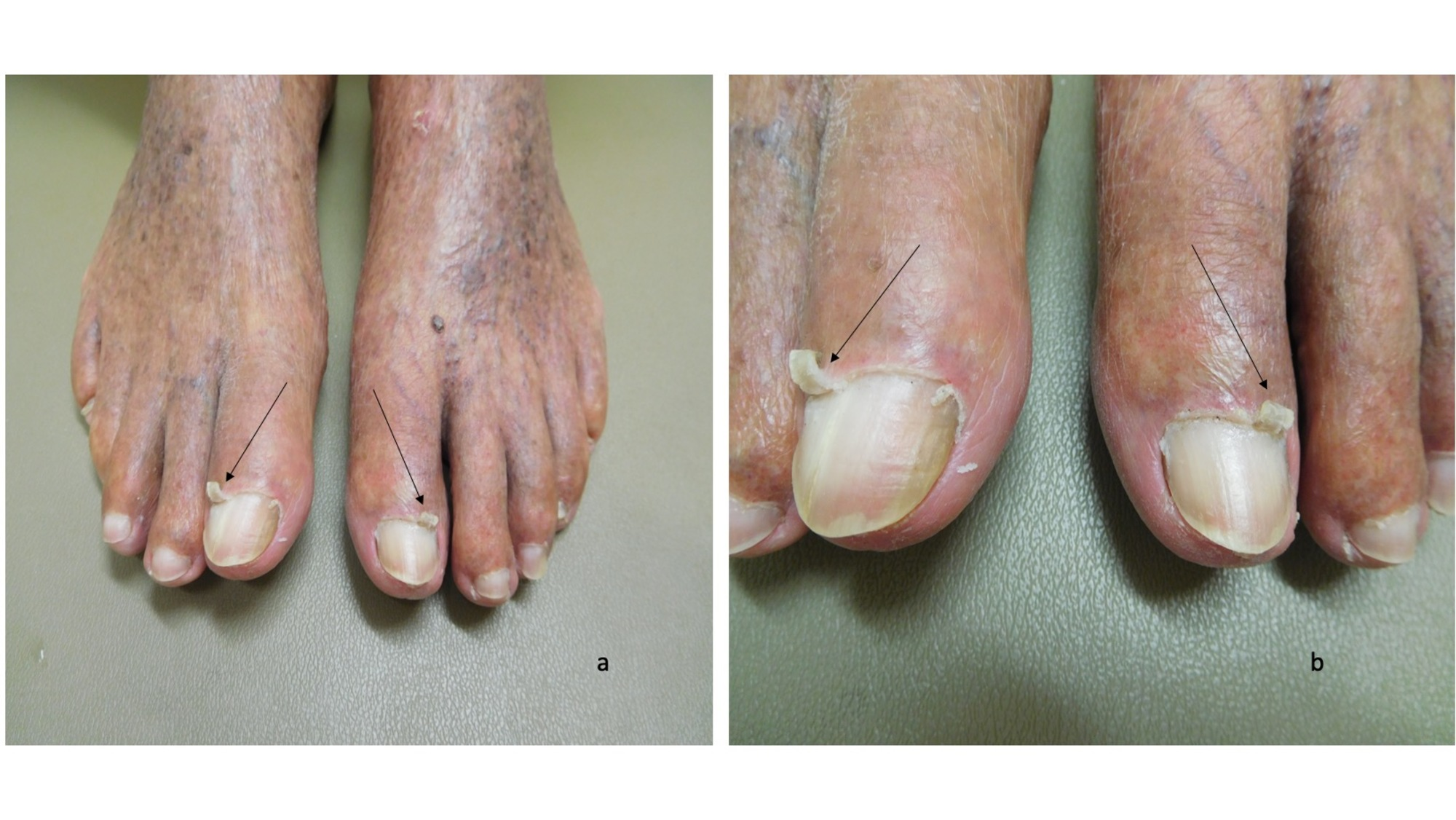 Cureus | Curling Cuticles of the Great Toenails: A Case Report of  Eponychogryphosis | Article
