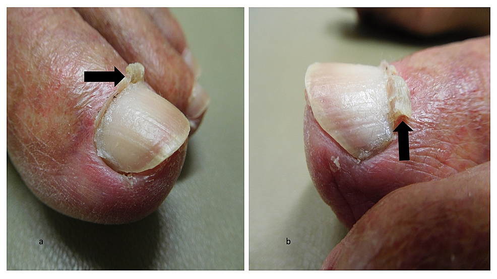 Cureus Curling Cuticles of the Great Toenails A Case Report of