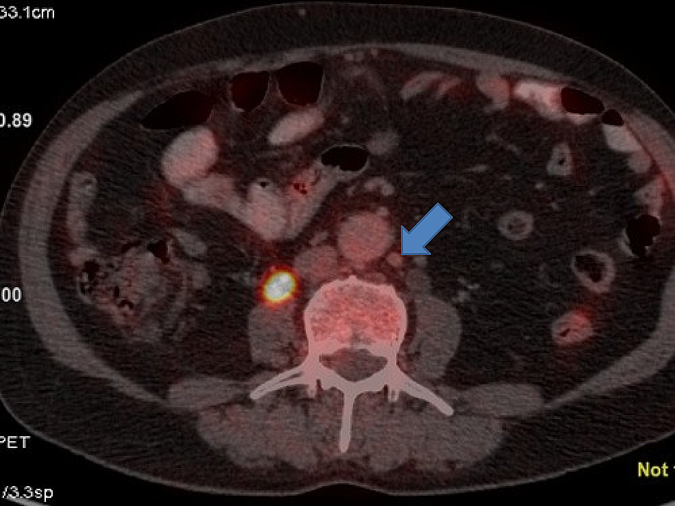 Positron-emission-tomography-(PET)-showing-a-para-aortic-lymph-node-measuring-about-1-cm-from-where-fine-needle-aspiration-cytology-(FNAC)-was-positive-for-malignant-cytology.