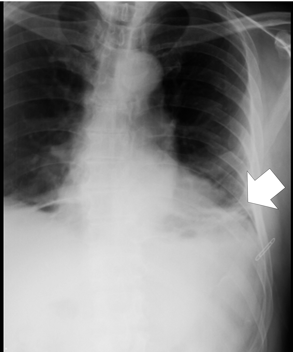 Cureus | Delayed Tension Hemothorax With Nondisplaced Rib Fractures ...