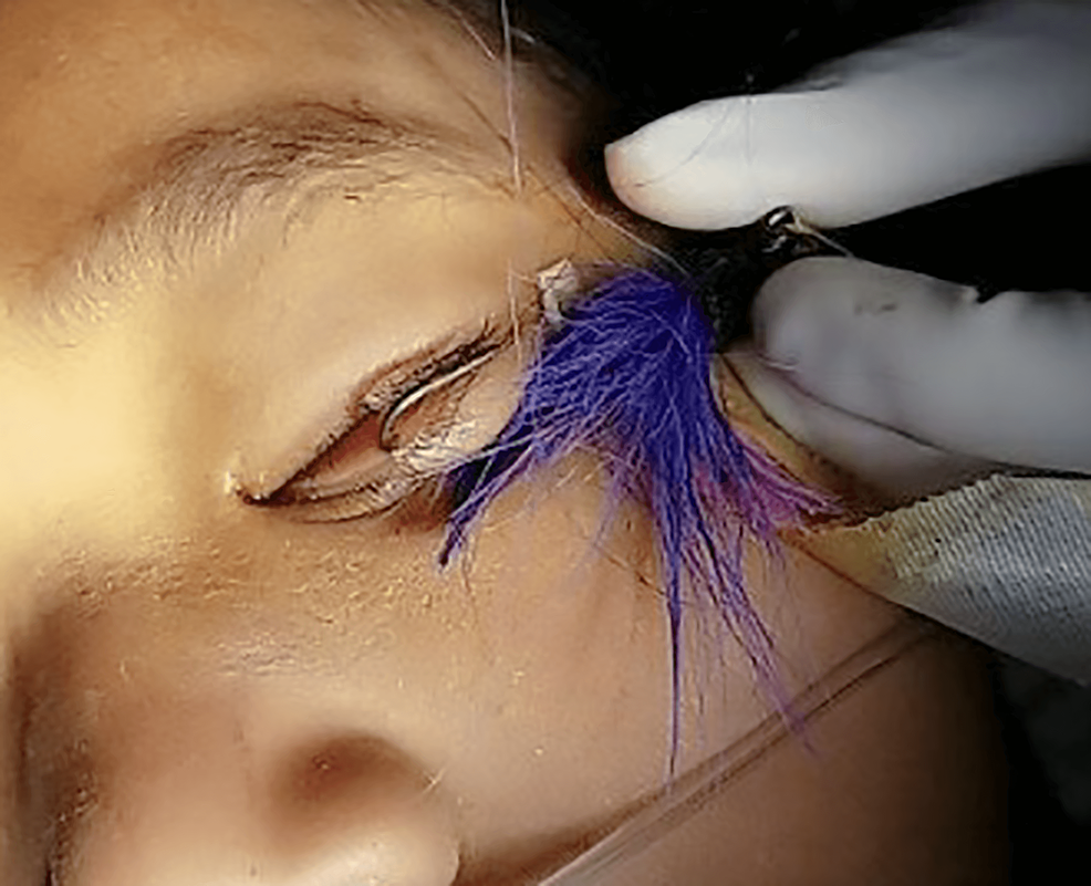 Cureus, Fishing for Trouble: A Novel Surgical Technique for Penetrating  Fishhook Injuries of the Eyelid