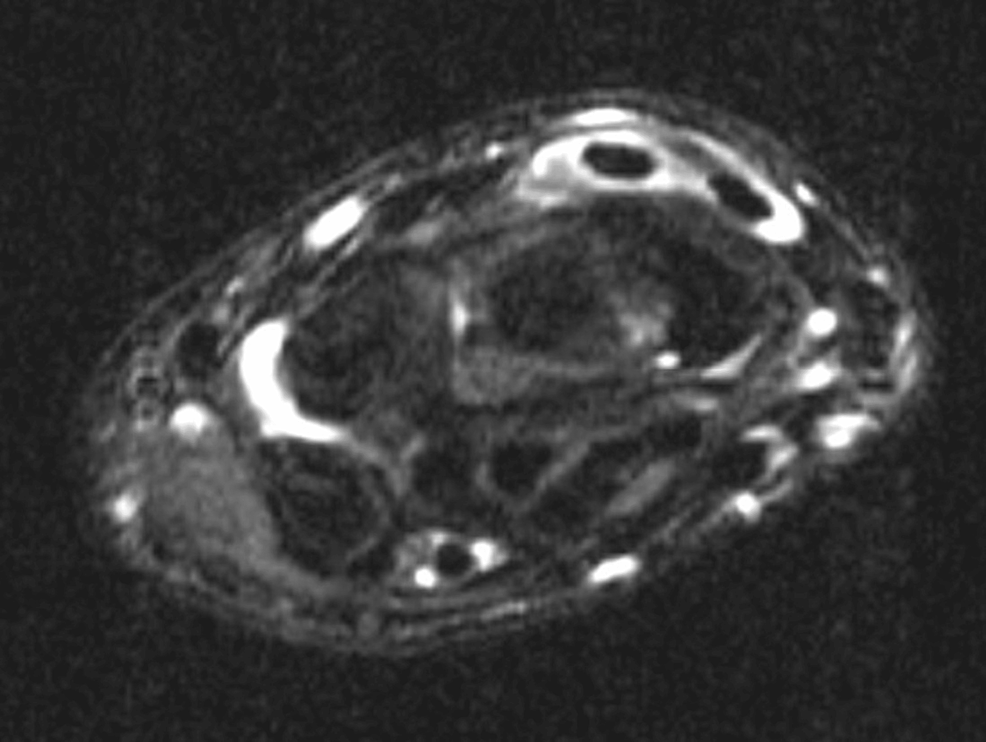 Cureus Distal Intersection Syndrome Between Second and Third Dorsal