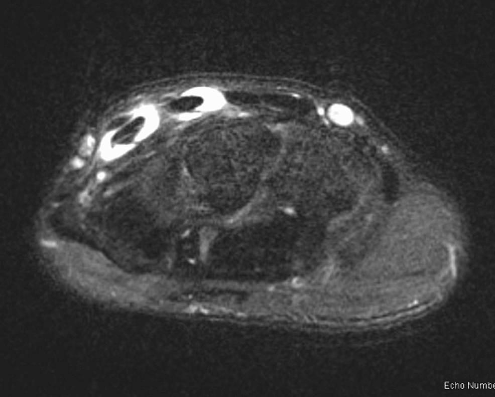 Cureus Distal Intersection Syndrome Between Second and Third Dorsal