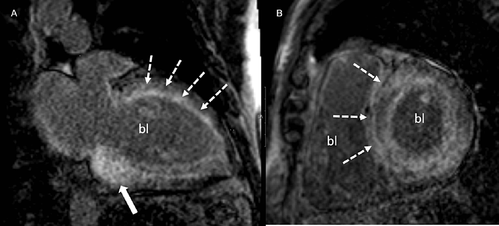 Three-dimensional Speckle Tracking Echocardiography in Light Chain