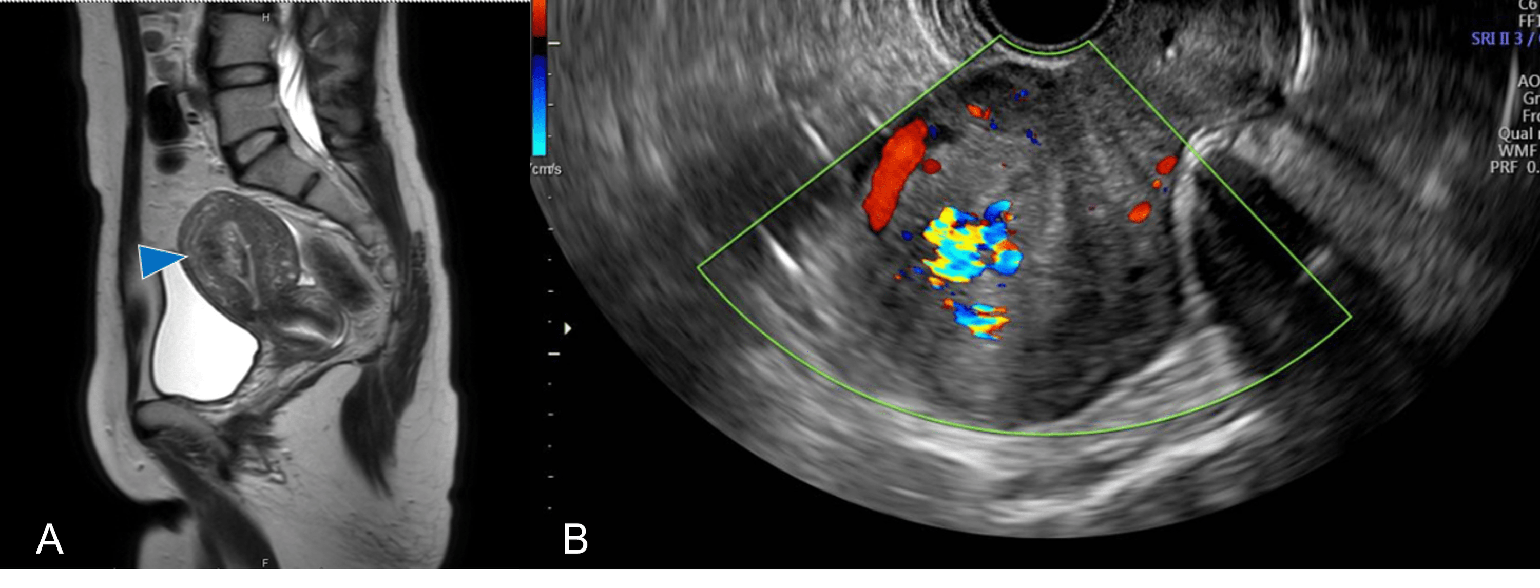 Cureus A Case of Placenta Accreta Infection Managed by Hysterectomy