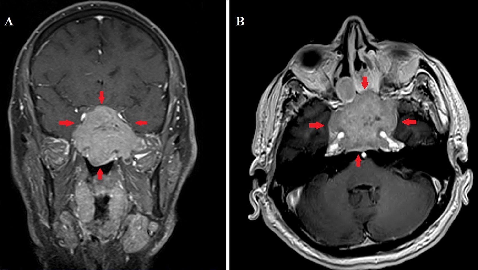 Cureus Carcinoid Tumor Arising From The Sphenoid Sinus Treated With Definitive Intensity Modulated Radiation Therapy A Case Report