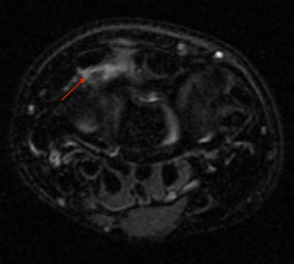 Cureus Distal Intersection Syndrome Between Second and Third Dorsal
