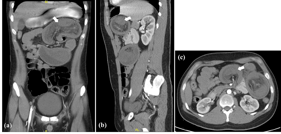 Cureus Atypical Peutz Jeghers Syndrome Presenting With A Huge