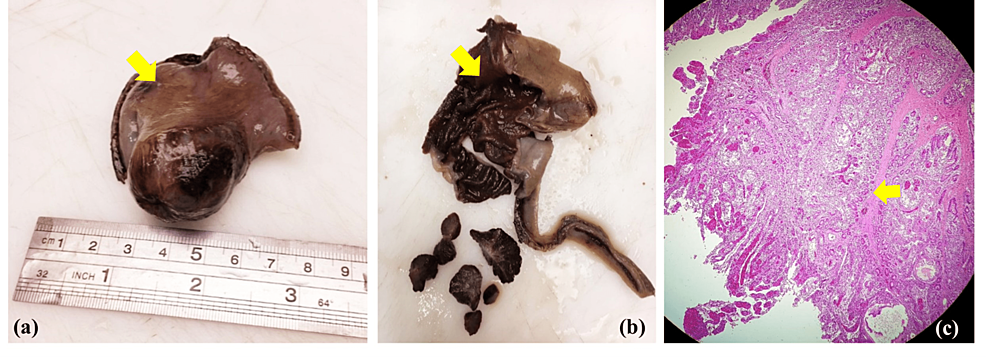 Atypical Peutz Jeghers Syndrome Presenting With A Huge Jejunojejunal