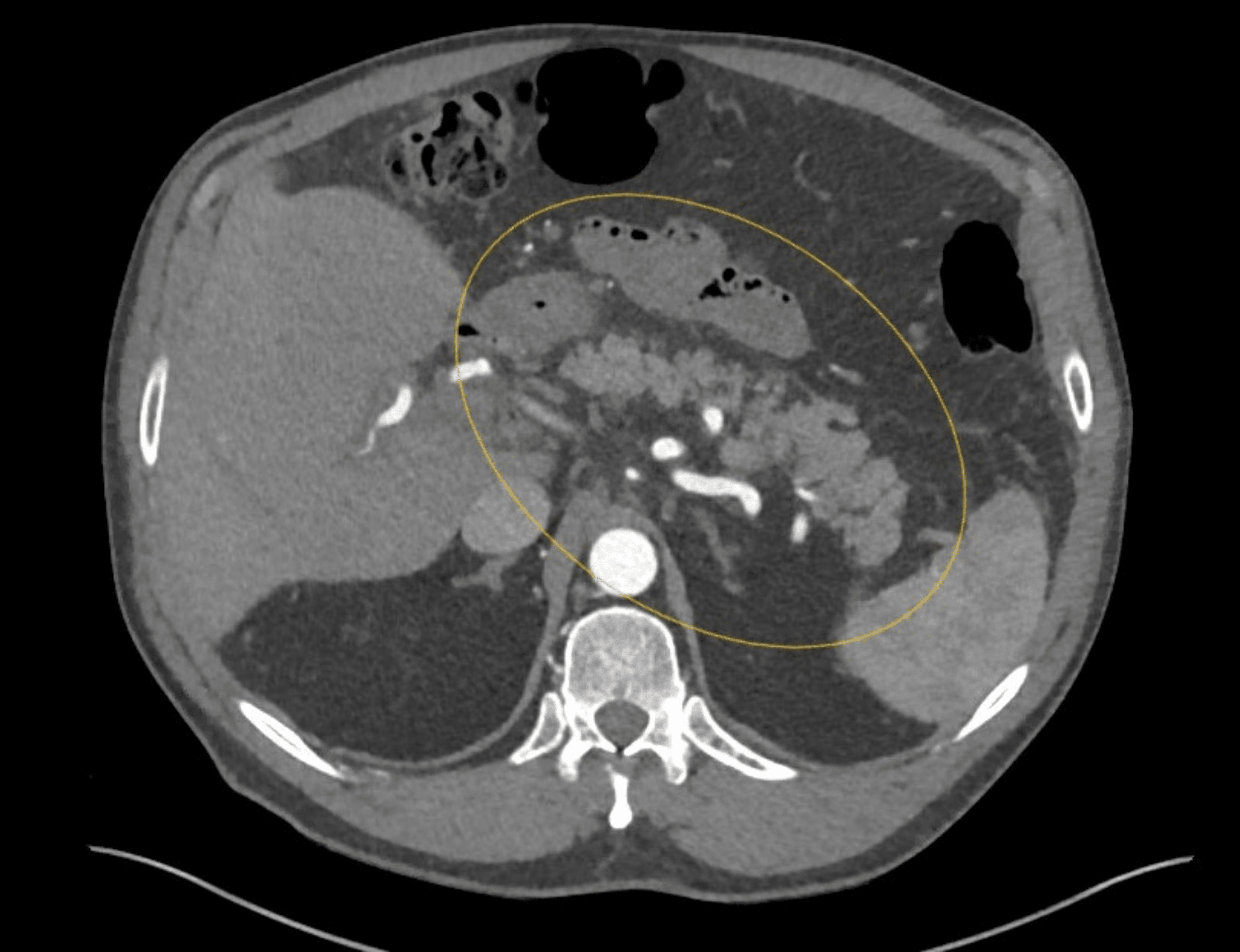 Portal Vein Thrombosis Extending To The Superior Mesenteric And Splenic ...