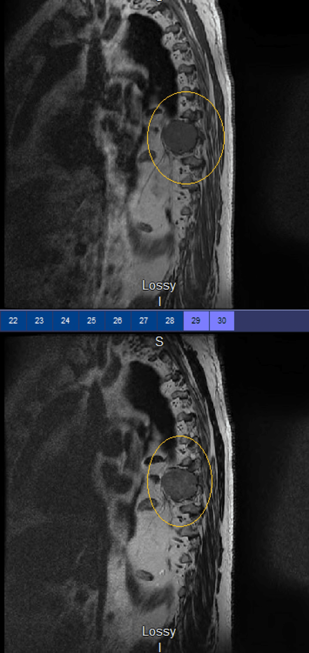 Cureus Chest Pain Caused by Thoracic Spine Plasmacytoma A Case Report