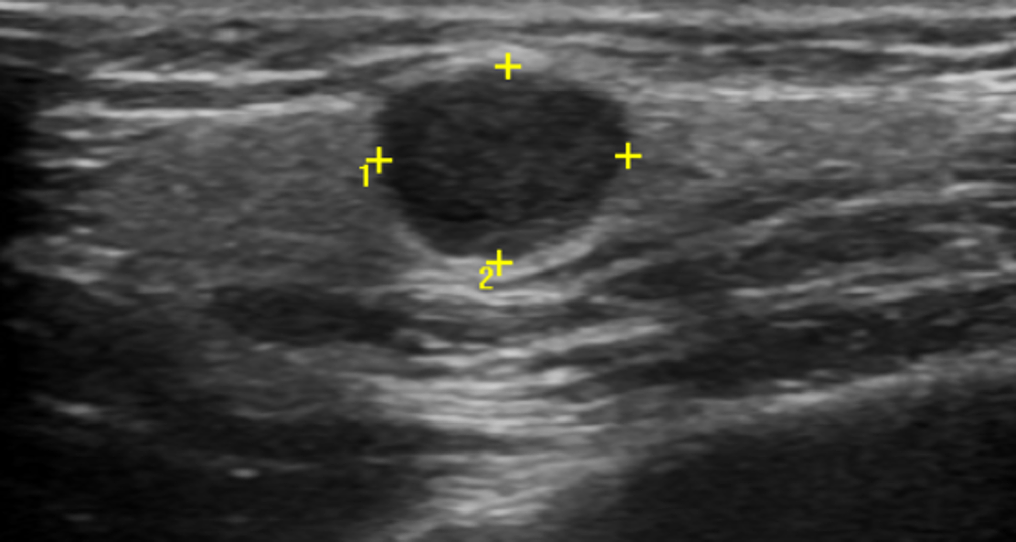 parotid gland tumor ultrasound