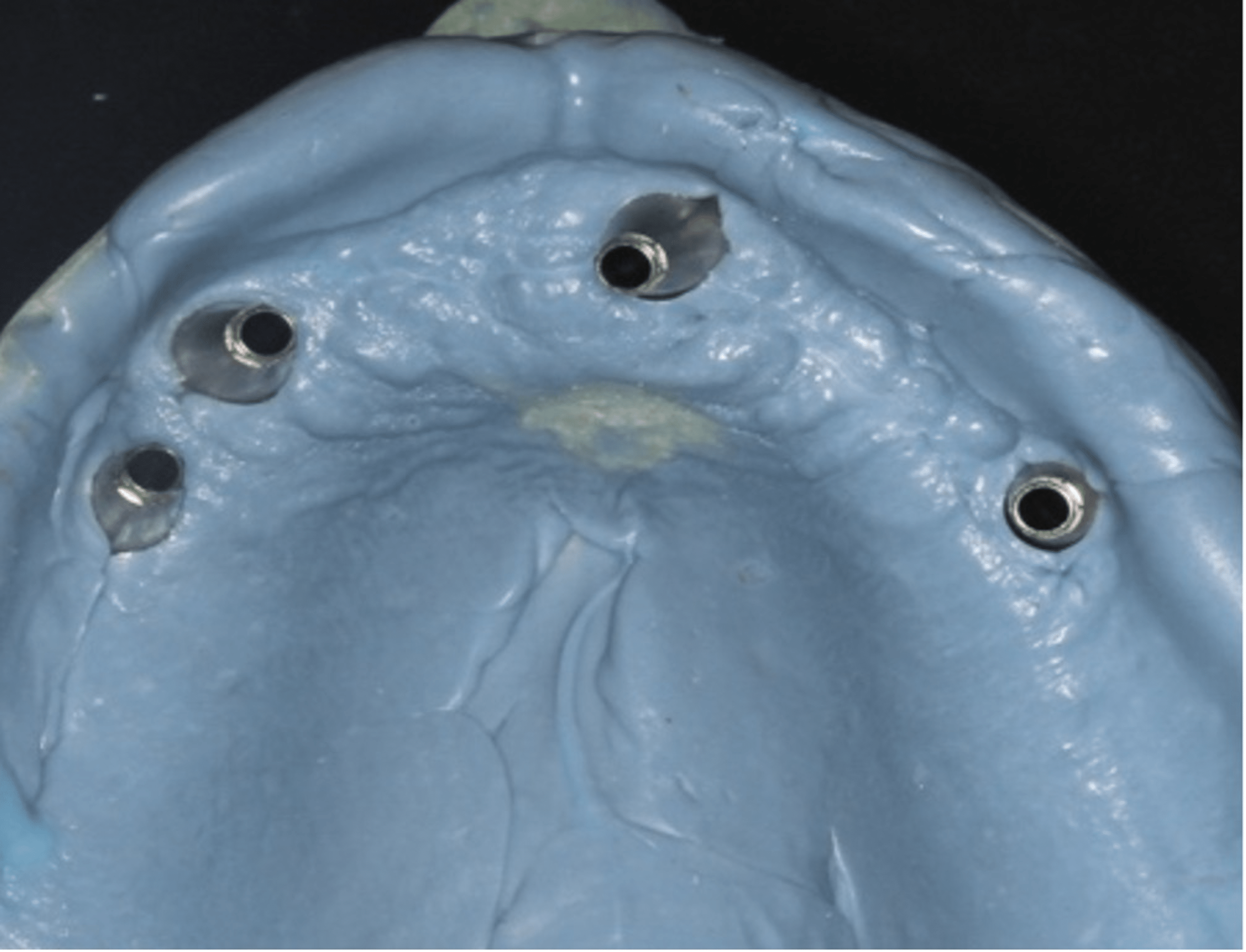 A Modified Ridge-Splitting Technique to Restore a Completely Edentulous ...