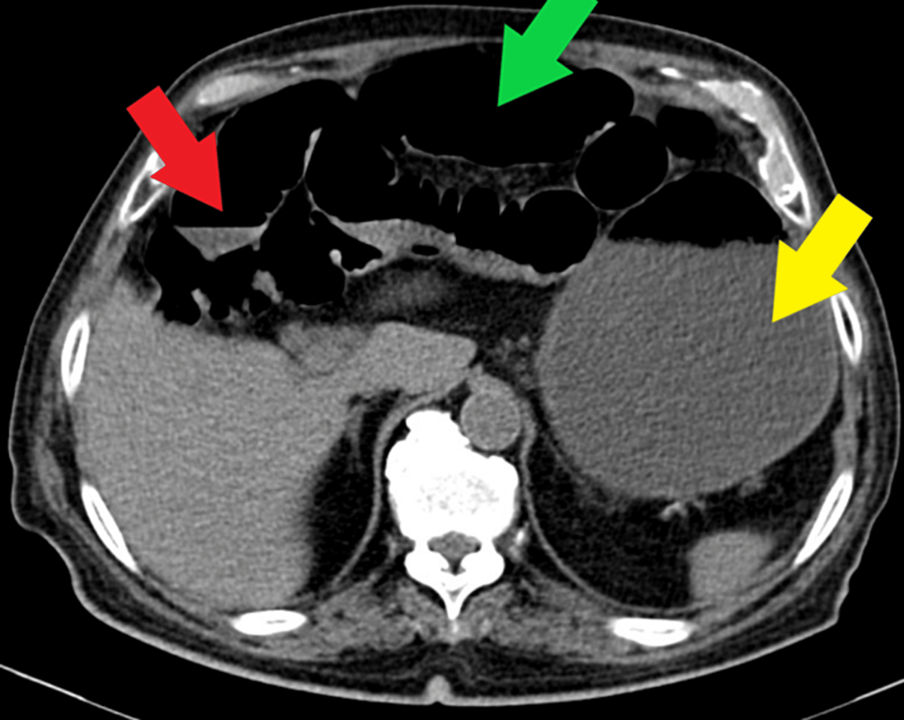 Meckel’s Diverticulum Causing A Small Bowel Obstruction In An 80-Year ...