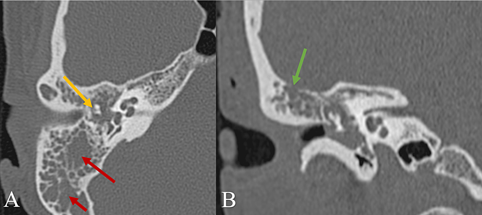 Cureus | Late Recurrence of a Rare Middle Ear Neuroendocrine Tumor With ...