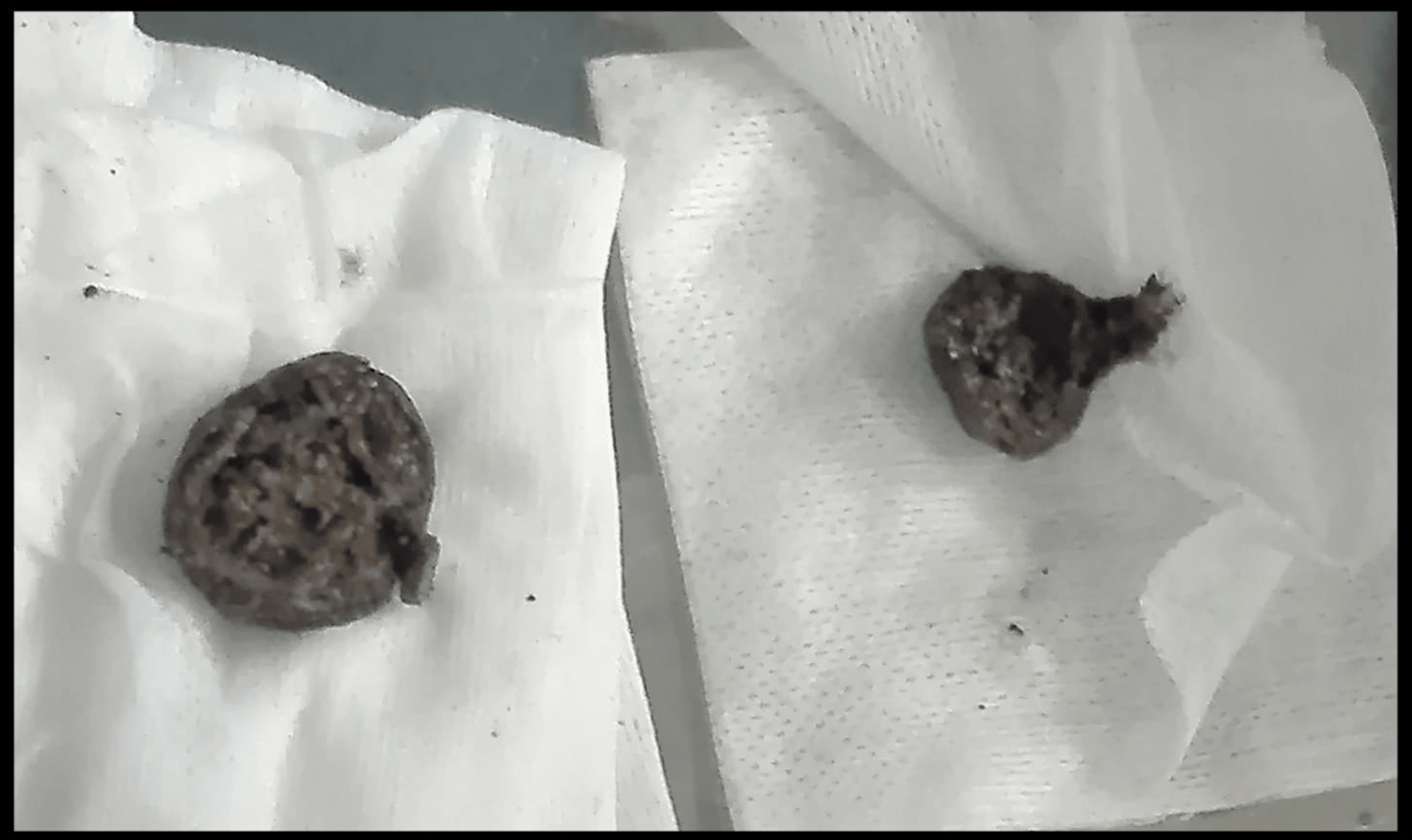 Cureus Rectal Bezoar A Rare Cause of Intestinal Obstruction