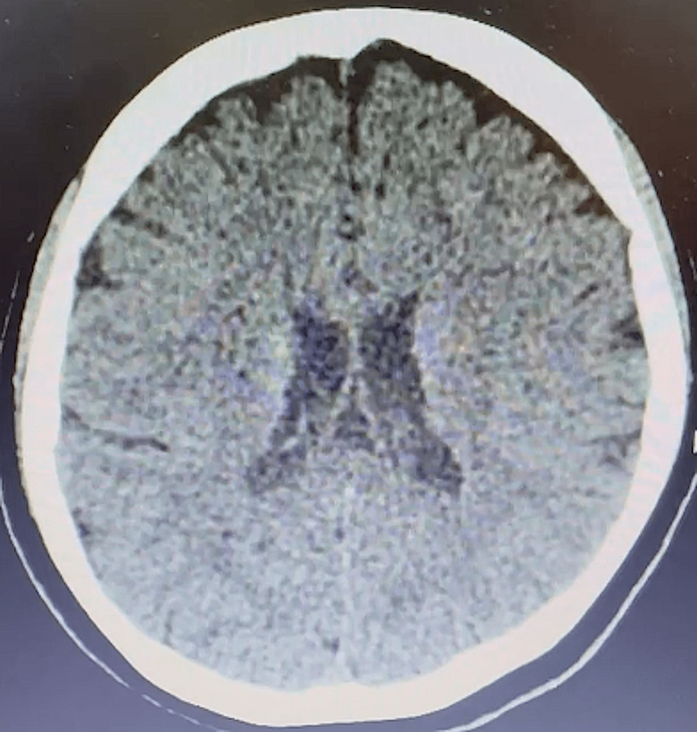 Cureus WallEyed Bilateral Internuclear Ophthalmoplegia as an Early