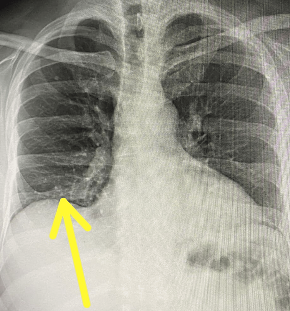 Cureus, Obstructive Sleep Apnea and Role of the Diaphragm