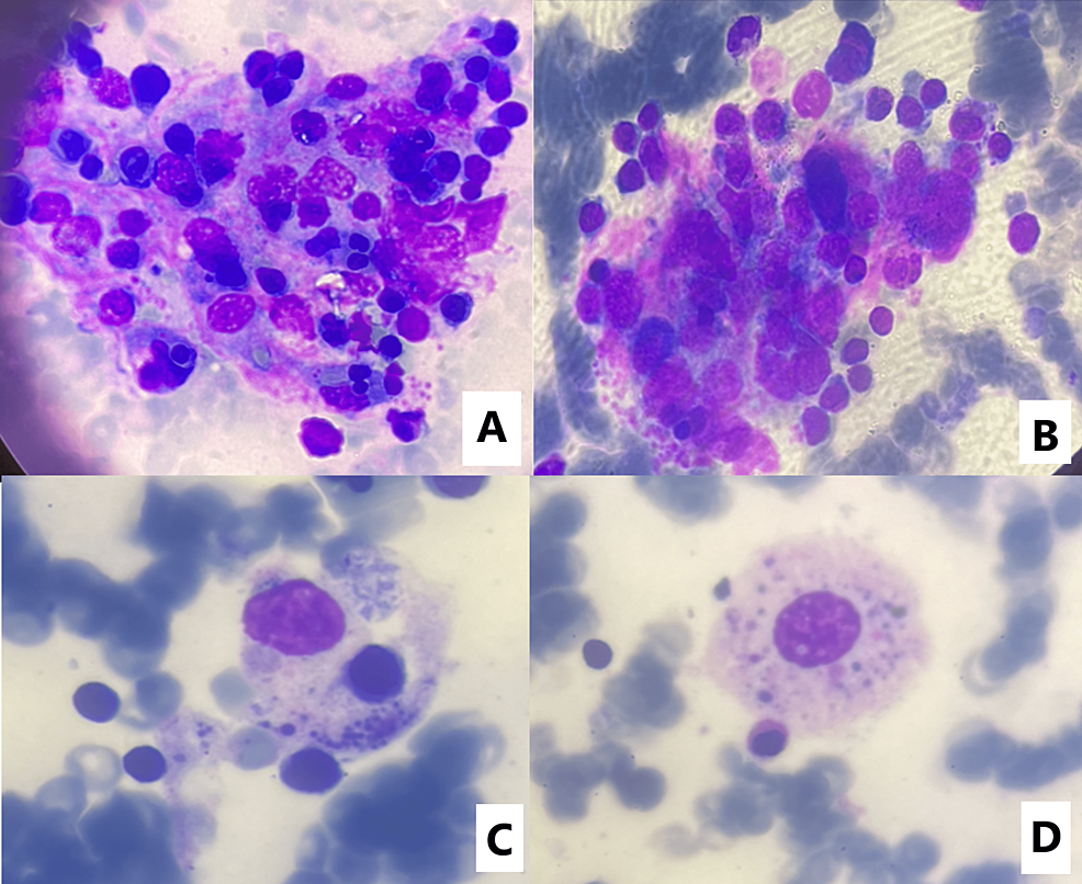 cureus-the-challenging-aspect-of-macrophage-activation-syndrome-in