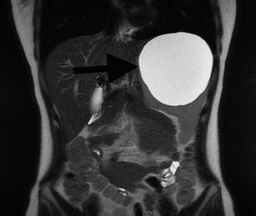 cureus-an-isolated-splenic-hydatid-cyst