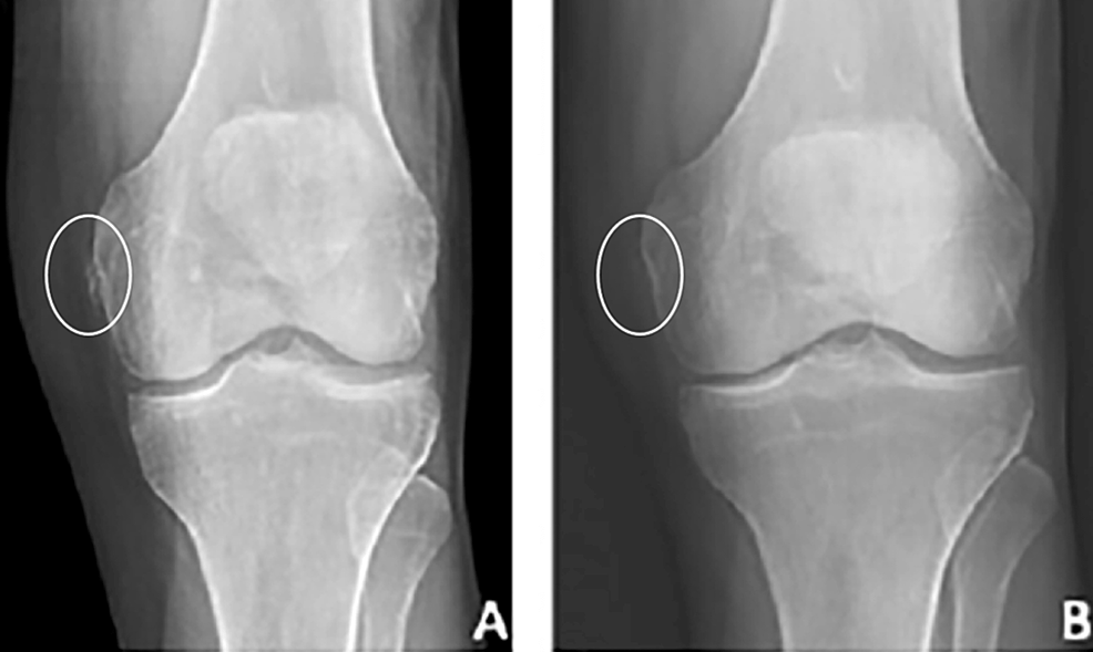 Cureus  Heterotopic Mineralization of the Medial Collateral Ligament: Our  Experience Treating Two Cases of Calcific Versus Ossific Lesions With  Ultrasonic Vacuum Debridement