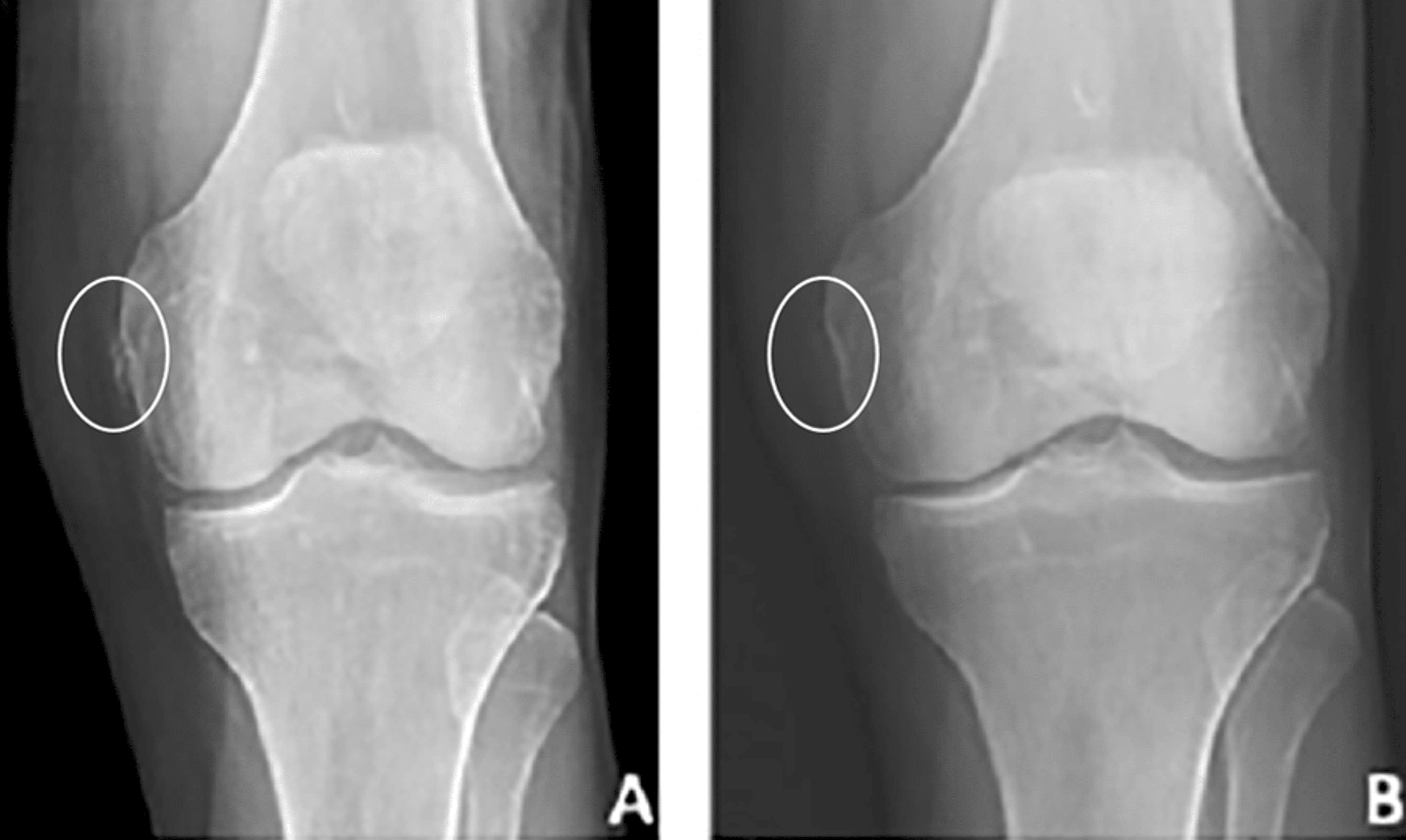 Heterotopic Mineralization of the Medial Collateral Ligament Our